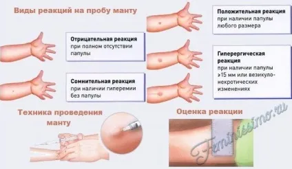 Щеплення новонародженим бцж - склад, правила вакцинації, реакції та ускладнення