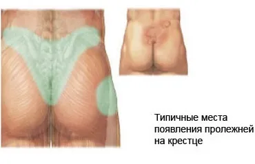 Пролежні профілактика, лікування, фітотерапія (Червона пляма шкірі) Пролежні профілактика, лікування, фітотерапія