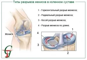 Розрив меніска колінного суглоба що робити і які наслідки (що робити) Розрив меніска колінного суглоба що робити і які наслідки