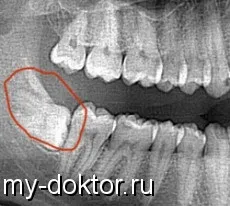 Рентген зубів збільшує ризик раку щитовидної залози (щитовидної) Рентген зубів збільшує ризик раку щитовидної залози