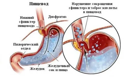 рефлюкс шлунка
