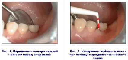 Резекція ясенних кишень