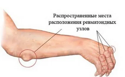 Ревматизм суглобів у дорослих - симптоми і лікування (дорослих) Ревматизм суглобів у дорослих - симптоми і лікування