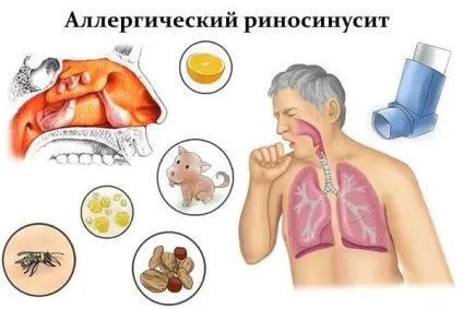 Риносинусит симптоми і лікування у дорослих (гострий і хронічний) (гострий) Риносинусит симптоми і лікування у дорослих (гострий і хронічний)