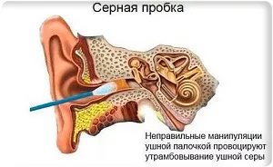Сірчана пробка у дитини - причини, симптоми і лікування (лікування) Сірчана пробка у дитини - причини, симптоми і лікування