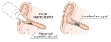 Сірчані пробки в вухах як видалити самостійно краплі, свічки, перекис відео (сірчані) Сірчані пробки в вухах як видалити самостійно краплі, свічки, перекис відео