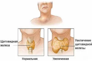 Щитовидна залоза - лікування народними засобами, рецепти (заліза) Щитовидна залоза - лікування народними засобами, рецепти
