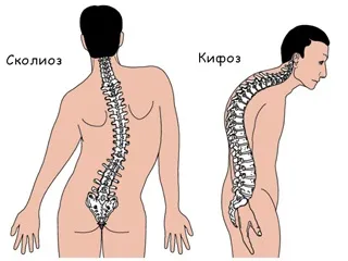 Шийний кіфоз (кифотическая деформація) (шийний) Шийний кіфоз (кифотическая деформація)