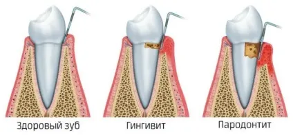 Шинування зубів при пародонтиті, шинування нижніх рухомих зубів після брекетів, ціни і фото,
