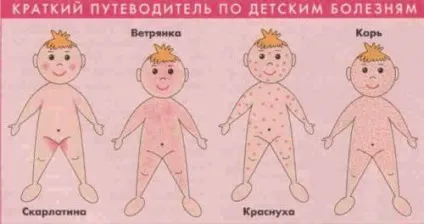 Висип на тілі у дитини на животі, спині або грудей, без температури (висип) Висип на тілі у дитини на животі, спині або грудей, без температури