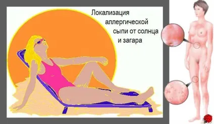 Висип після засмаги