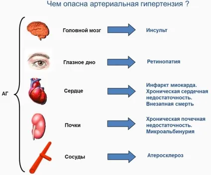 Симптоматична вторинна артеріальна гіпертензія - що це таке (таке) Симптоматична вторинна артеріальна гіпертензія - що це таке