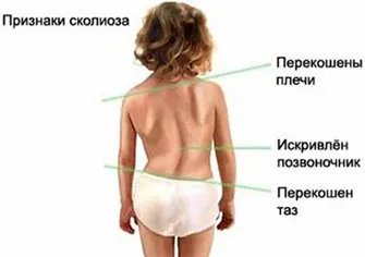 Сколіоз у дітей, як лікувати дитину зі сколіозом (дітей) Сколіоз у дітей, як лікувати дитину зі сколіозом