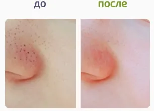 Spot cleaner - очищувач пор для обличчя відгуки, ціна (spot) Spot cleaner - очищувач пор для обличчя відгуки, ціна