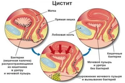 Спазми внизу живота у жінок основні причини (спазми) Спазми внизу живота у жінок основні причини