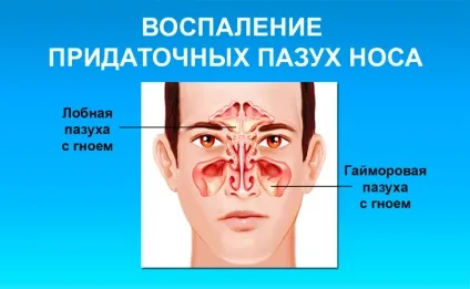 Спрей від гаймориту для лікування носа (лікування) Спрей від гаймориту для лікування носа