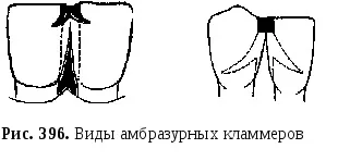 Ставропольська державна медична академія (Опорно утримує кламмер типу) Ставропольська державна медична академія
