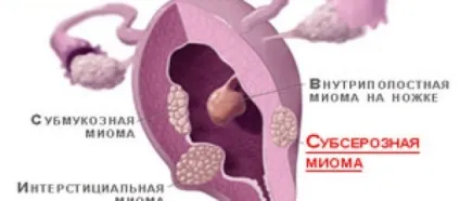 Субсерозний міоматозний вузол