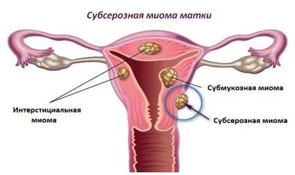 Субсерозний міоматозний вузол
