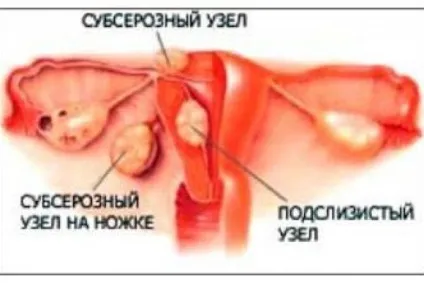 Субсерозний міоматозний вузол