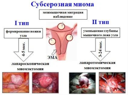 Субсерозний міоматозний вузол