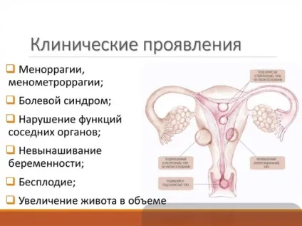 Субсерозний міоматозний вузол
