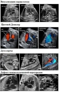 Своєчасно зроблена ехокардіографія серця плоду - кращий спосіб убезпечити матір і дитину (дитини) Своєчасно зроблена ехокардіографія серця плоду - кращий спосіб убезпечити матір і дитину