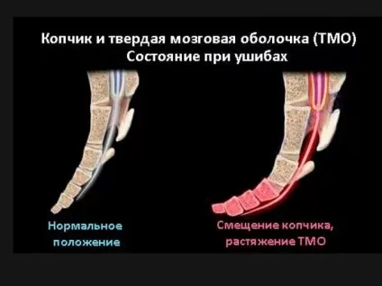 Травма куприка симптоми лікування народними засобами (симптоми) Травма куприка симптоми лікування народними засобами