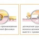 Видалення волосся воском в домашніх умовах швидко і безболісно (домашніх) Видалення волосся воском в домашніх умовах швидко і безболісно