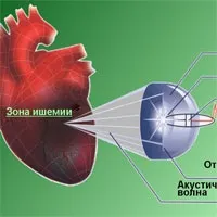 Ударно-хвильова терапія серця (увтс)