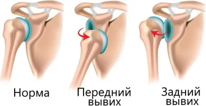 Забій плеча при падінні - не піднімається рука (забій) Забій плеча при падінні - не піднімається рука