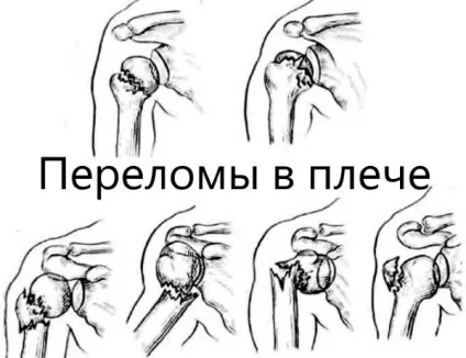 Забій плеча при падінні - не піднімається рука (забій) Забій плеча при падінні - не піднімається рука