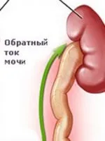 Узі сечового міхура з визначенням залишкової сечі (залишкової) Узі сечового міхура з визначенням залишкової сечі