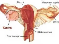 Ретенційні утворення лівого яєчника, причини виникнення, лікування (яєчника) Ретенційні утворення лівого яєчника, причини виникнення, лікування