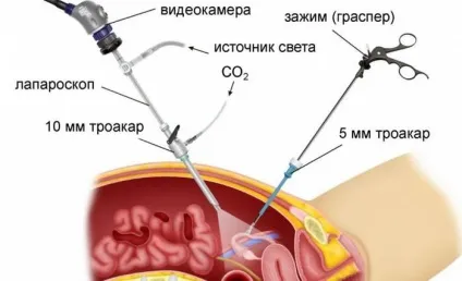 Ретенційна кіста правого і лівого яєчника причини виникнення та лікування (кіста) Ретенційна кіста правого і лівого яєчника причини виникнення та лікування