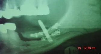 Вертикальна 3d аугментація верхньої і нижньої щелеп з метою підготовки до дентальної імплантації (вертикальна) Вертикальна 3d аугментація верхньої і нижньої щелеп з метою підготовки до дентальної імплантації