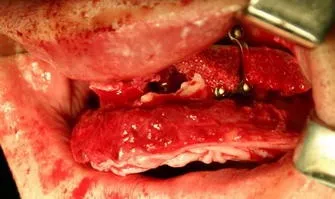 Вертикальна 3d аугментація верхньої і нижньої щелеп з метою підготовки до дентальної імплантації (нижньої) Вертикальна 3d аугментація верхньої і нижньої щелеп з метою підготовки до дентальної імплантації