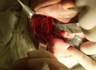 Вертикальна 3d аугментація верхньої і нижньої щелеп з метою підготовки до дентальної імплантації (дентальної) Вертикальна 3d аугментація верхньої і нижньої щелеп з метою підготовки до дентальної імплантації