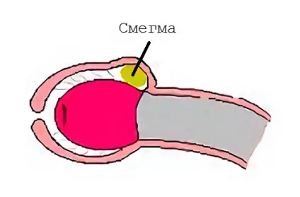 Виділення при ерекції норма або сигнал про розвивається патології (патології) Виділення при ерекції норма або сигнал про розвивається патології