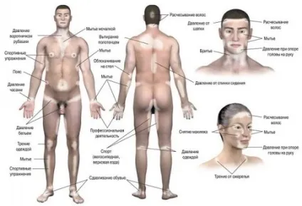 Вітіліго що потрібно знати про це захворювання, портал естетика (білі плями на шкірі вітіліго) Вітіліго що потрібно знати про це захворювання, портал естетика