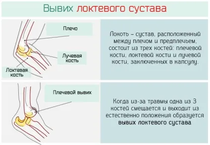 Вивих ліктя - прояви, лікування і наслідки вивиху ліктьового суглоба (лікування) Вивих ліктя - прояви, лікування і наслідки вивиху ліктьового суглоба