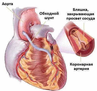Вперше виникла стенокардія причини, симптоми і лікування (лікування) Вперше виникла стенокардія причини, симптоми і лікування