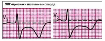 Вперше виникла стенокардія причини, симптоми і лікування (що виникла) Вперше виникла стенокардія причини, симптоми і лікування