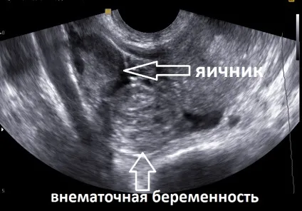 Чи шкідливо узі робити на ранніх термінах вагітності реальність і домисли