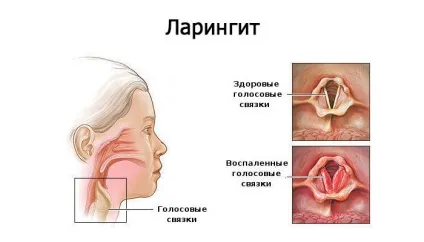 Яблучний оцет при ангіні - як правильно полоскати горло (оцет) Яблучний оцет при ангіні - як правильно полоскати горло
