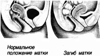 загин матки