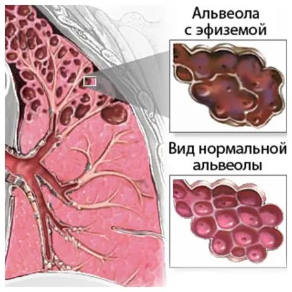 Захворювання легенів - симптоми, лікування, профілактика (легких) Захворювання легенів - симптоми, лікування, профілактика