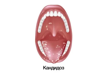 Здорові гланди як виглядає горло хворе і здорове