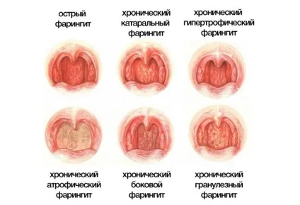 Здорові гланди як виглядає горло хворе і здорове