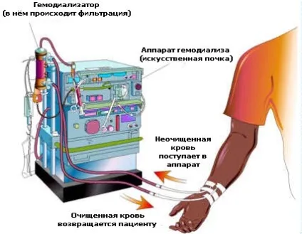 Замісна терапія програмний гемодіаліз, перитонеальний діаліз